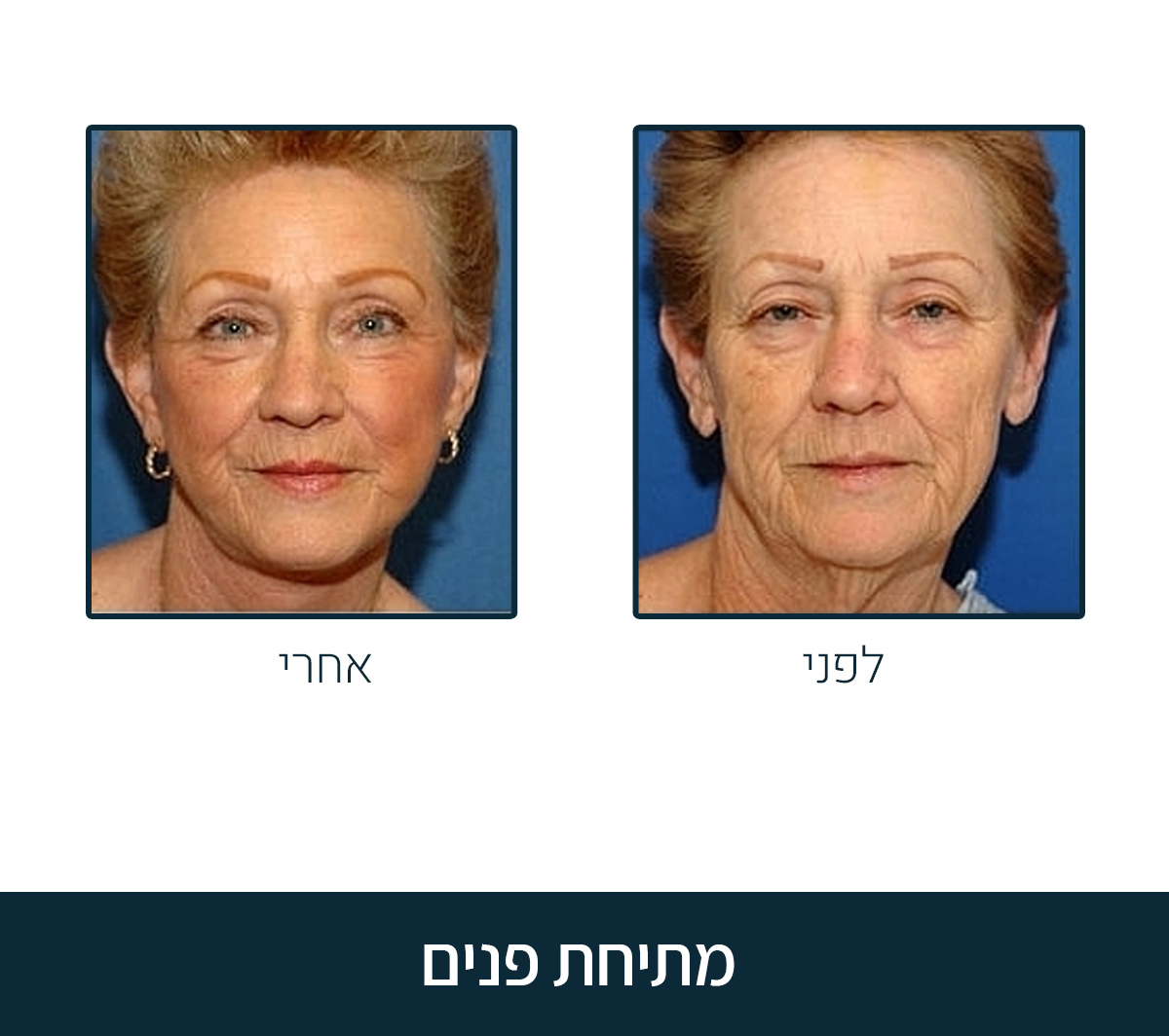 ניתוח מתחית פנים לפני ואחרי דר וינברג
